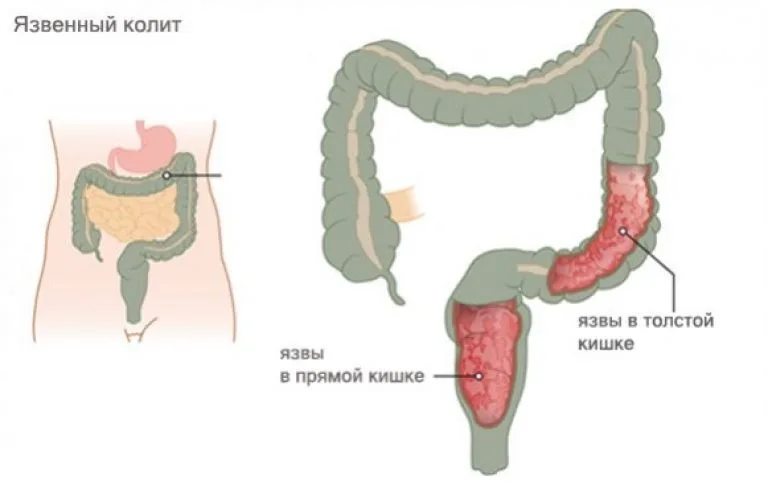 Берут ли в армию с колитом?